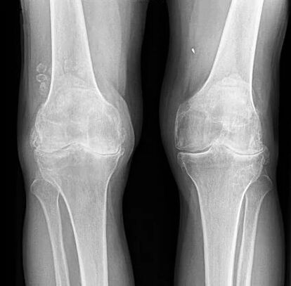 prevenirea osteoartritei genunchiului